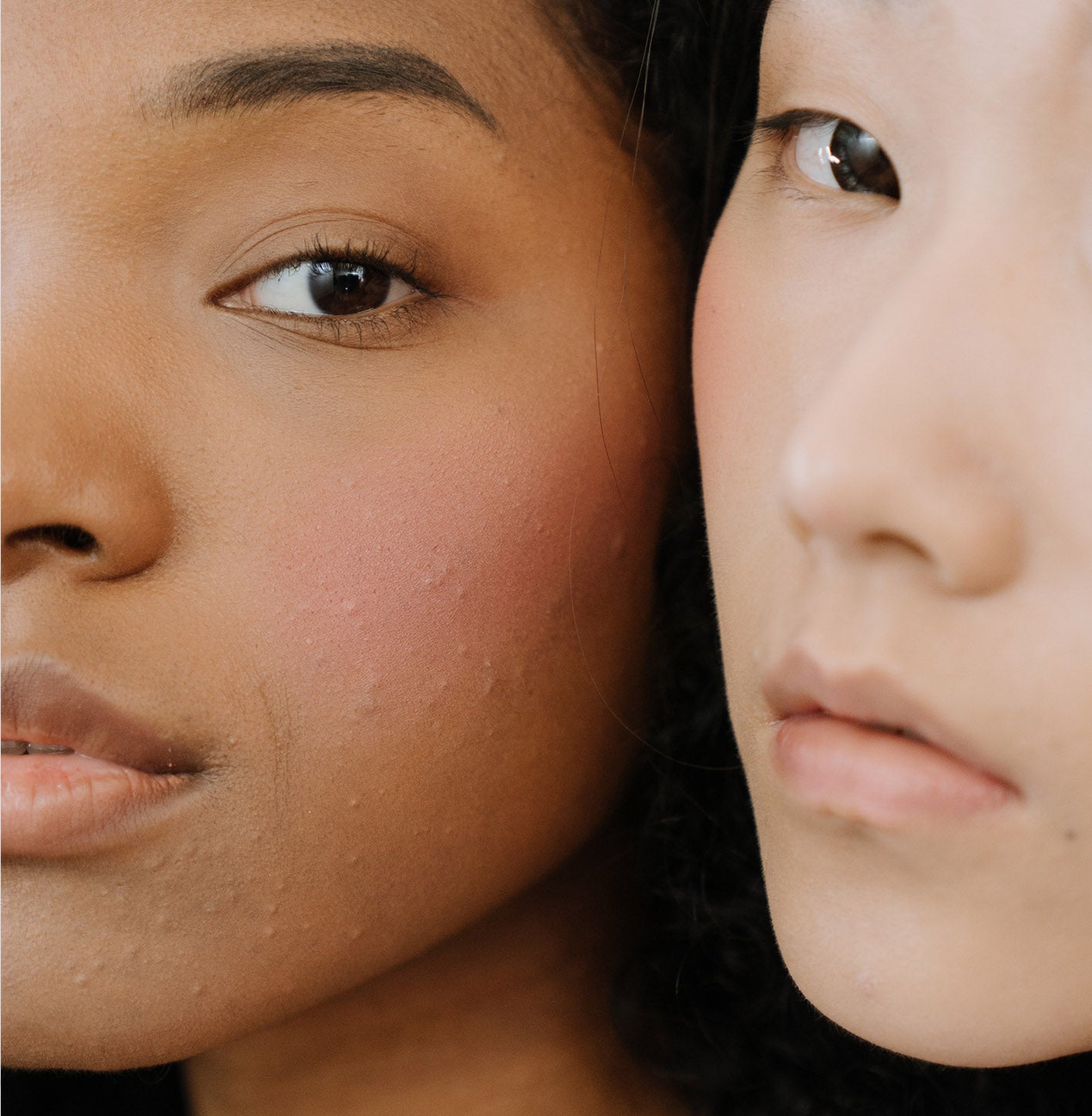 Types d'acné et comment les traiter